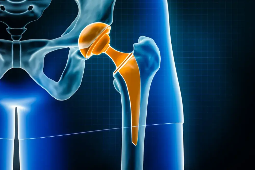 Ilustração de prótese total de quadril implantada no fêmur e no acetábulo